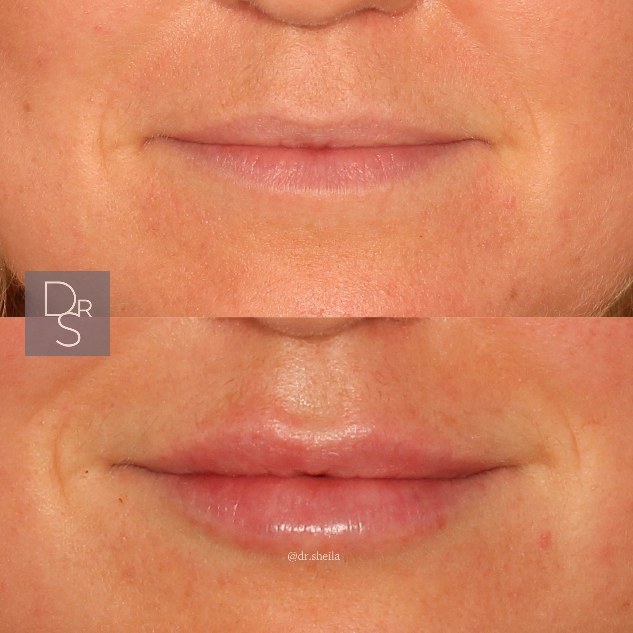 Lips4